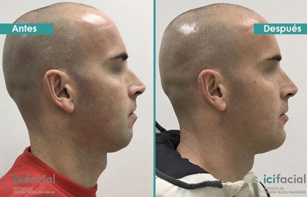 Caso de paciente al que se aumentó el mentón con lipofilling de su propia grasa