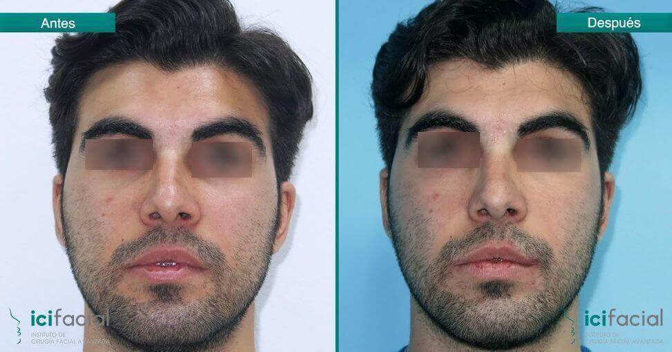 Operación de bichectomía de hombres en Madrid por Dr Macía