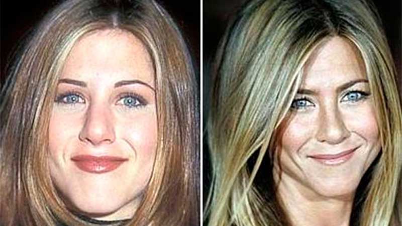 Antes y después en la bichectomía de Kim Kardashian