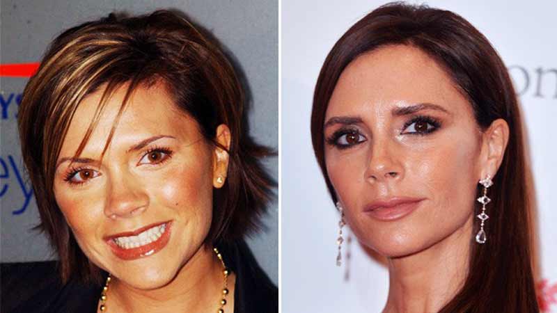 Antes y después en la bichectomía de Victoria Beckam