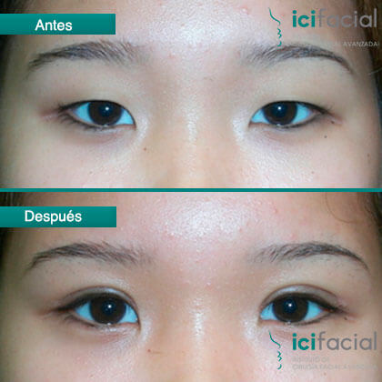 Mujer asiatica realizada cantopexia