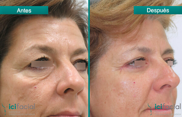 Mujer sometida a una blefaroplastia completa con elevación y cantopexia en Madrid