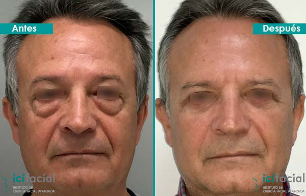 Hombre operado de blefaroplastia completa por Dr. Macía