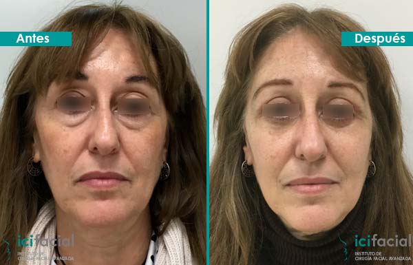 Mujer operada de blefaroplastia completa por Dr. Macía