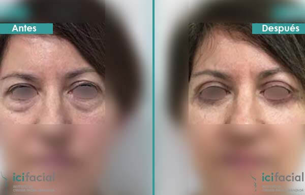 Blefaroplastia completa antes y después frontal