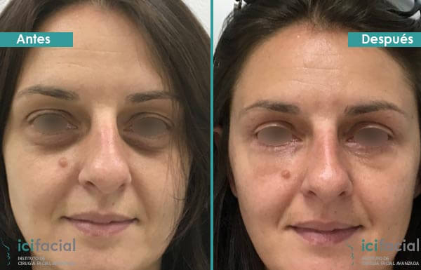 Blefaroplastia antes y después en mujer con lipofilling infraorbitario