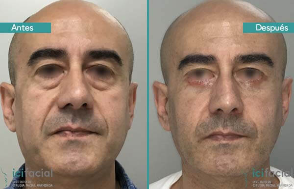 Blefaroplastia inferior hombre antes y después