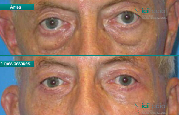 Blefaroplastia de hombre antes y después