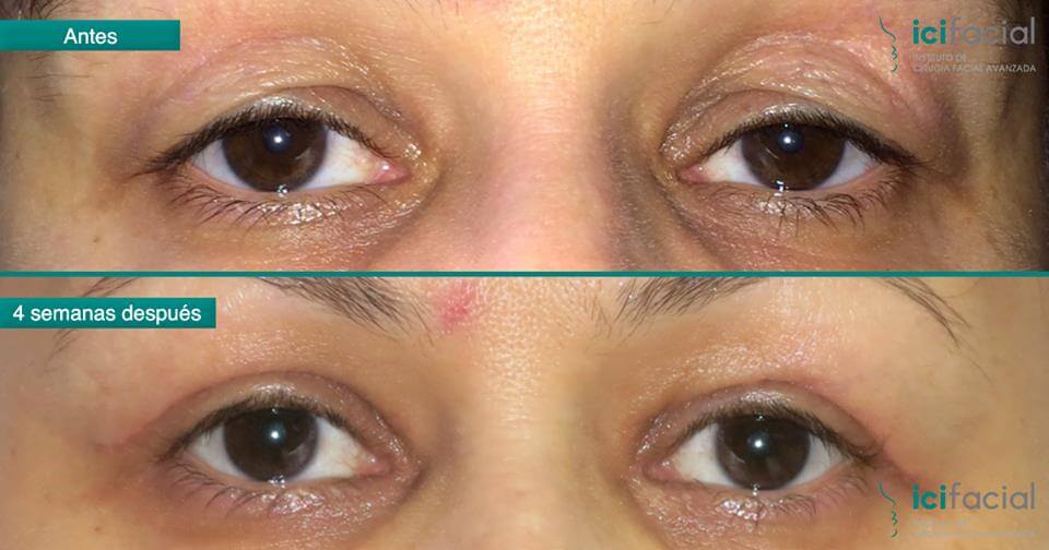 Mujer operada por párpados de ojos caidos