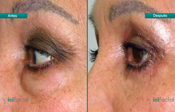 Blefaroplastia superior e inferior