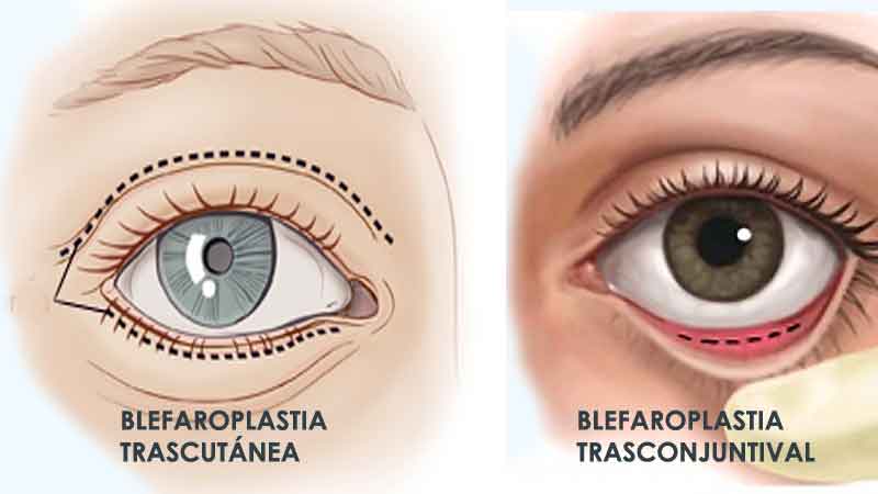 Diferencias entre blefaroplastia trasconjuntival y trascutanea