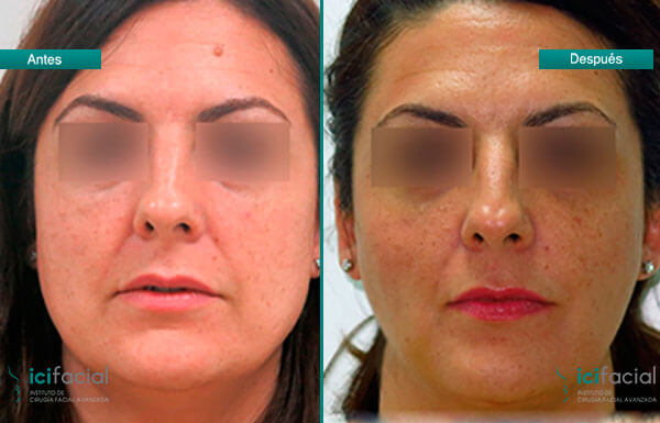 Bichectomía en mujer, para un rostro más armónico con Icifacial.