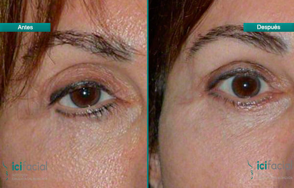 Blefaroplastia con cantoplastia antes y después