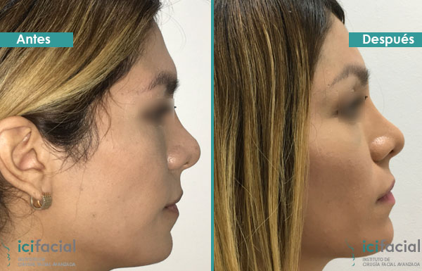 Feminización facial antes y después: frontoplastia y rinoplastia.
