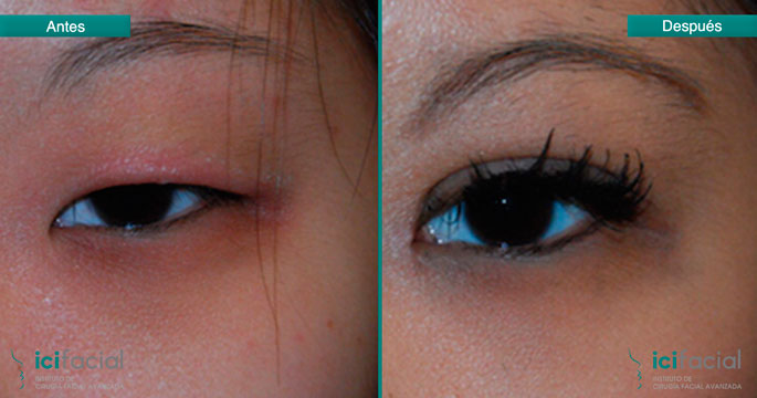 Cirugía de párapdos asiática