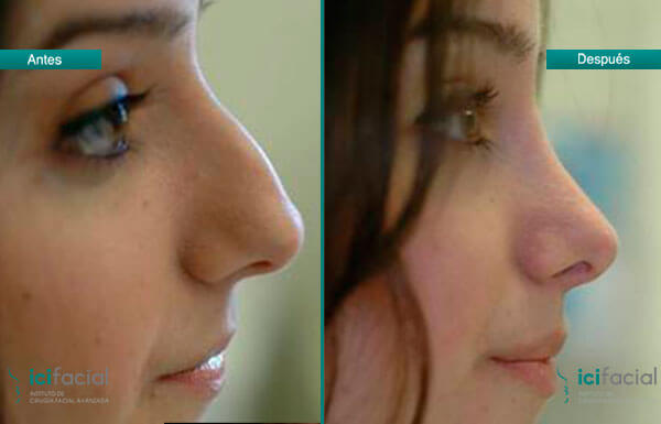 Cirugías faciales populares: rinoplastia