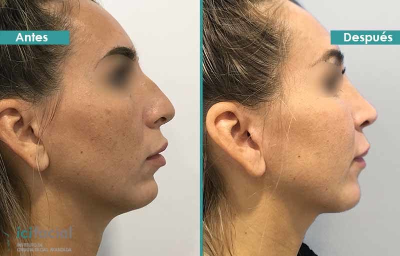 Rinoplastia y cirugía del mentón