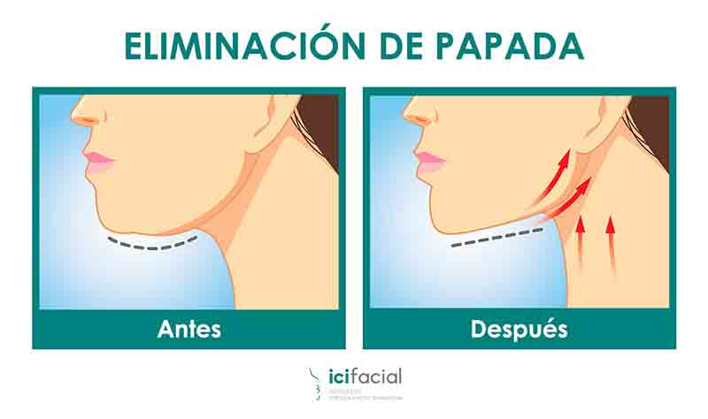 Eliminación de papada por aspiración y lipo de grasa en cuello
