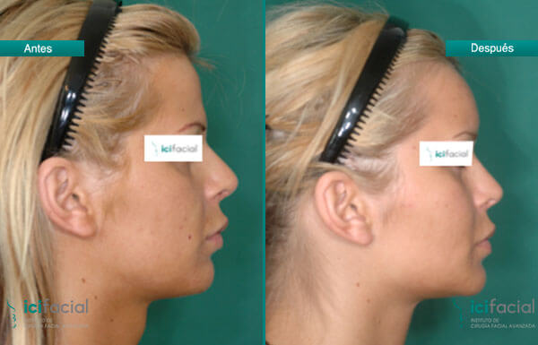 Casos reales de feminización facial antes y después por Dr. Macía