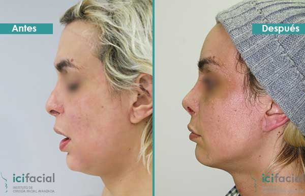 Paciente operado de rinoplastia en feminización facial en Madrid