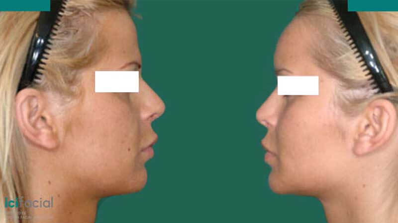 Cirugía de feminización en pacientes de transgenero