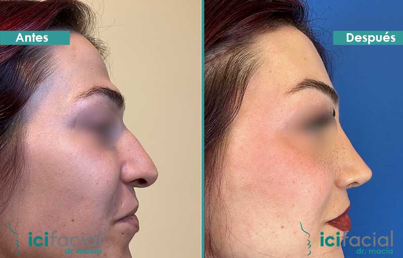 Feminización de frontoplastia y rinoplastia