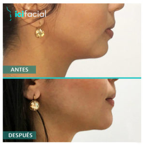 Mentoplastia de avance 