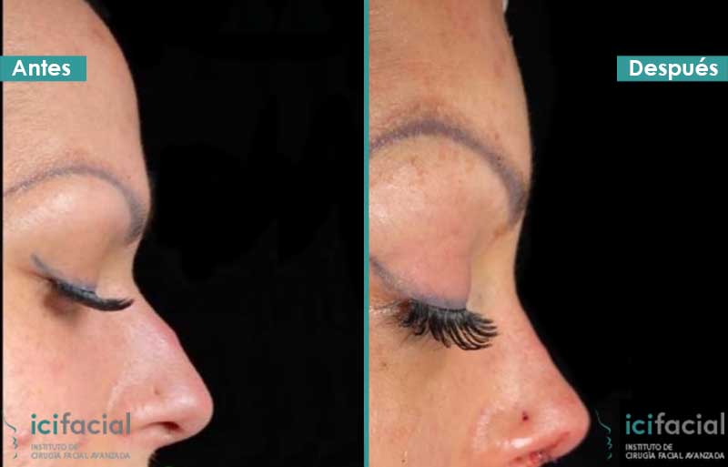 Frontoplastia de feminización