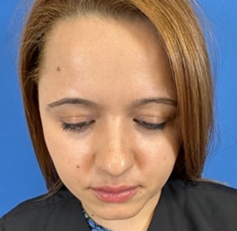 Fotografía de frente cabeza abajo para valoración de rinpolastia por el Doctor Macía