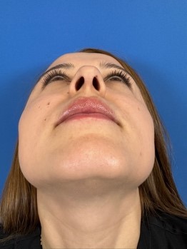 Fotografía de frente cabeza arriba para valoración de rinpolastia por el Doctor Macía