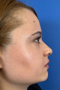 Fotografía de perfil derecho para valoración de rinpolastia por el Doctor Macía