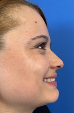 Fotografía de perfil derecho sonriendo para valoración de rinpolastia por el Doctor Macía