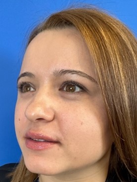 Fotografía de medio perfil izquierdo para valoración de rinpolastia por el Doctor Macía