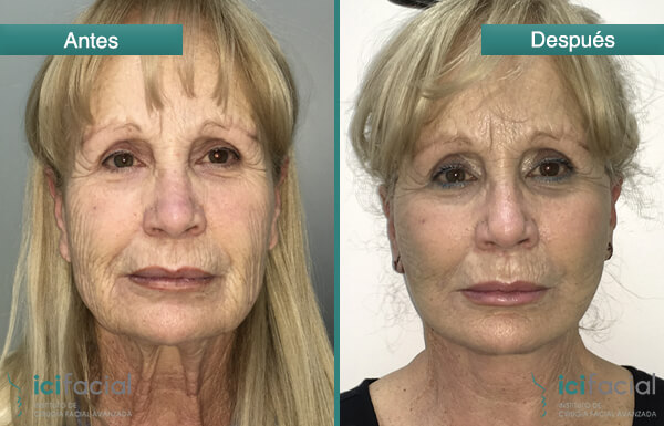 Mujer operada de lifting cuello y cervico facial