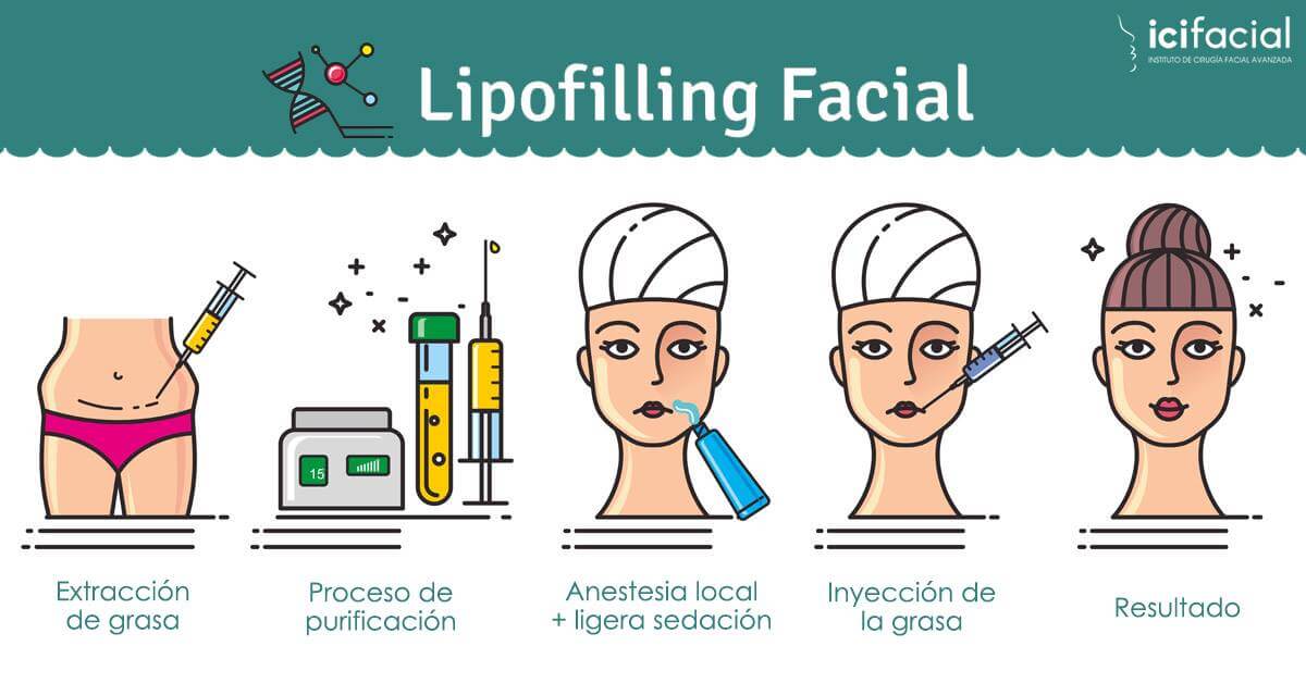 Pasos necesarios para un lipofilling facial