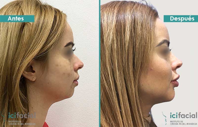 Mentoplastia de avance y eliminación de papada