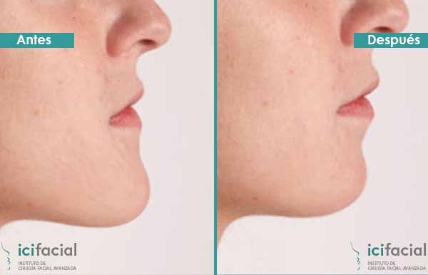Mentoplastia de reducción en Madrid