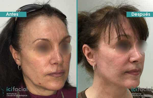 Minilifting facial antes y después en mujer por Dr Macia