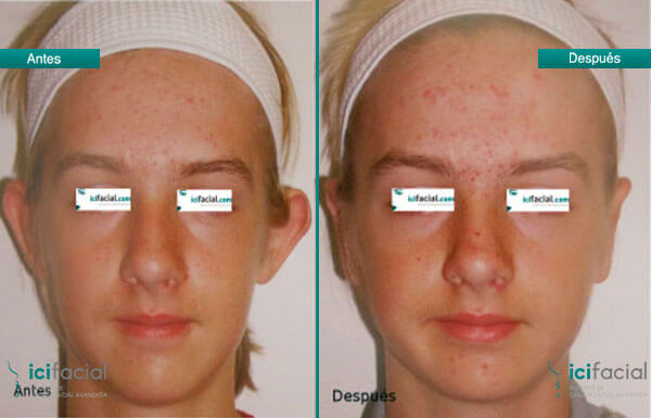 Otoplastia en chica adolescente