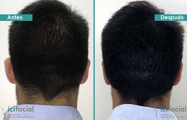 Operación de otoplastia antes y después en hombre adulto