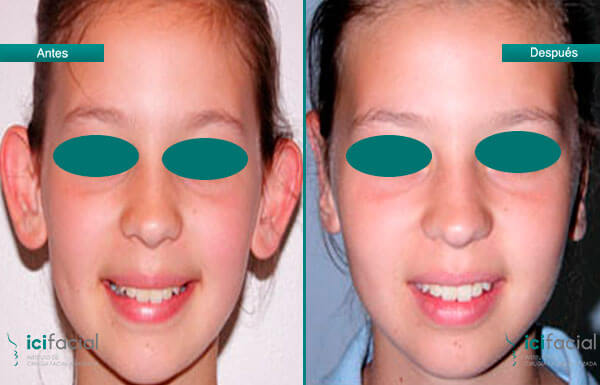 Otoplastia en niña