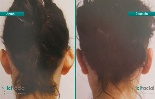 Otoplastia en chica joven, para una orejas perfectas. Iicfacial clínica especializada en cirugía