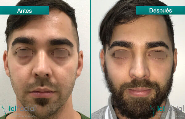 Relleno de párpados con grasa de paciente