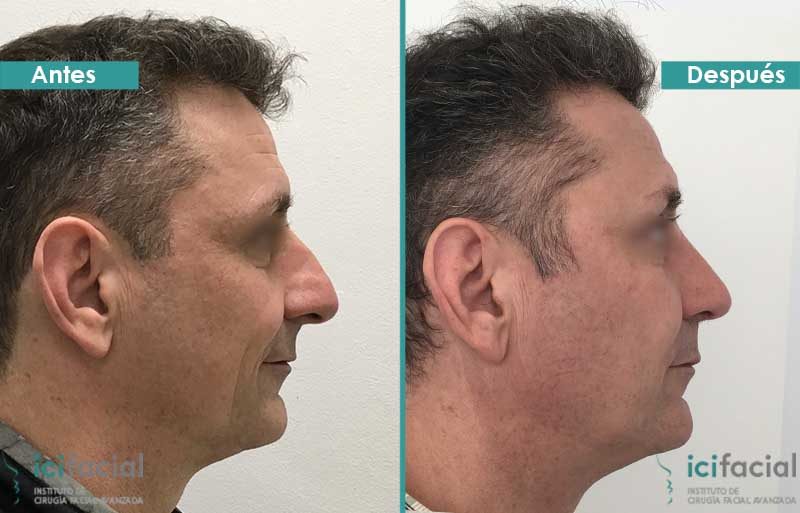 Rinoplastia antes y despues de hombre en Madrid por Doctor Macia