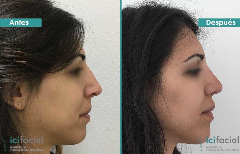 Rinoplastia antes y después en Madrid