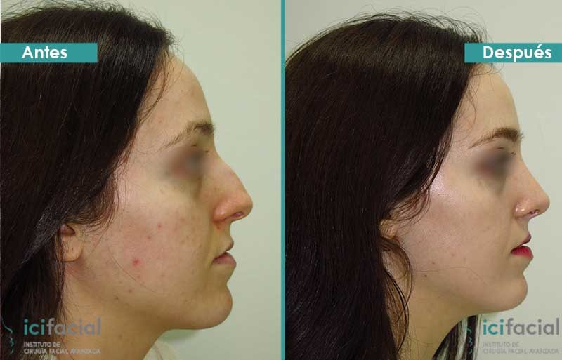 Rinoplastia antes y después operada por Dr. Macía