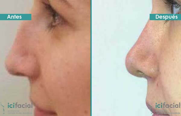 Rinoplastia mujer antes y después