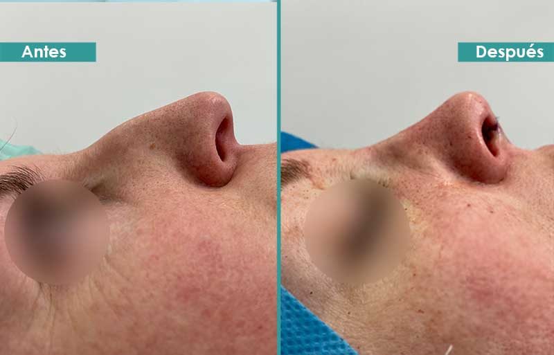 Rinoplastia ultrasónica justo antes y después de operación