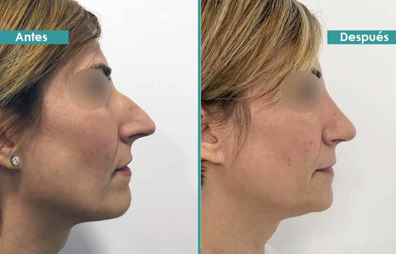 Rinoplastia de desproyección de la punta