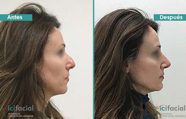 Rinoplastia ultrasónica con desviación de tabique